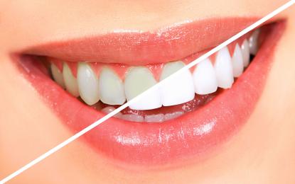 Làm thế nào để tẩy trắng răng an toàn và hiệu quả?