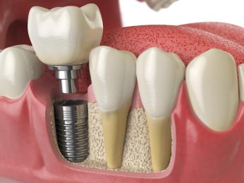 Ưu điểm và nhược điểm của Dental Implants (cấy ghép nha khoa)
