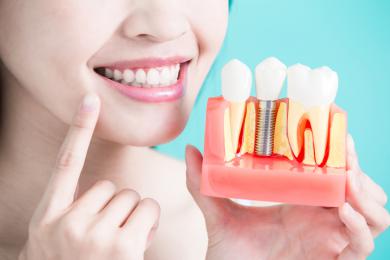 Cấy ghép Implant - Giải pháp hoàn hảo cho người mất răng