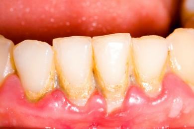 Vì sao răng của chúng ta lại xuất hiện những mảng bám 