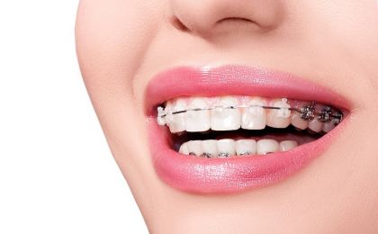 Những điều cần nhớ để có 1 hàm răng đẹp